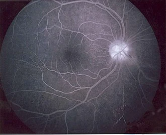 Exemplo de angiografia da retina. Imagem ilustrativa.